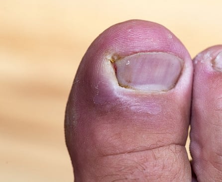 Ongle incarné