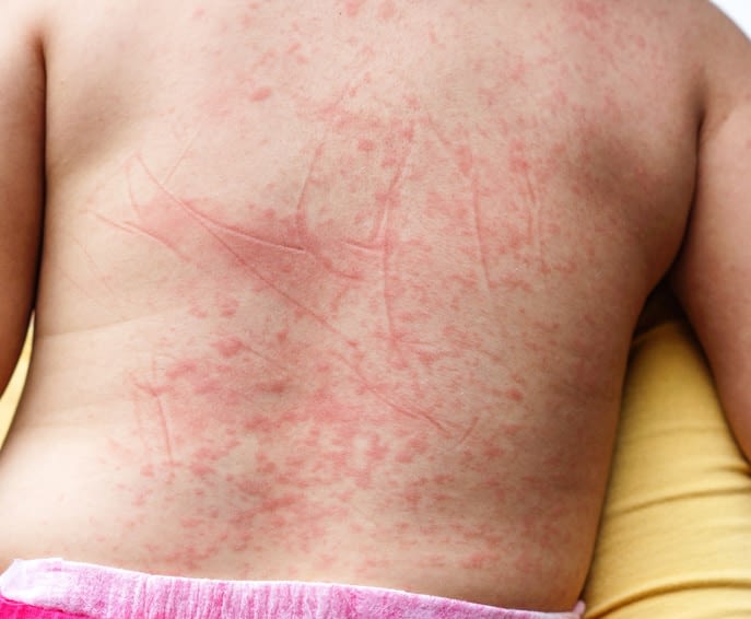 La fièvre de dengue La fièvre de dengue